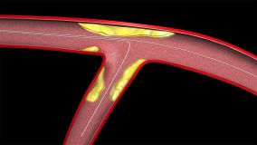 Angioplasty_001.jpg