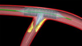 Angioplasty_002.jpg