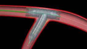 Angioplasty_003.jpg