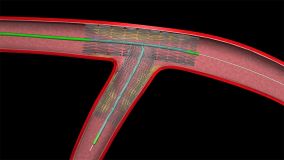 Angioplasty_004.jpg