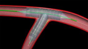 Angioplasty_005.jpg