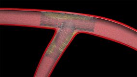 Angioplasty_006.jpg